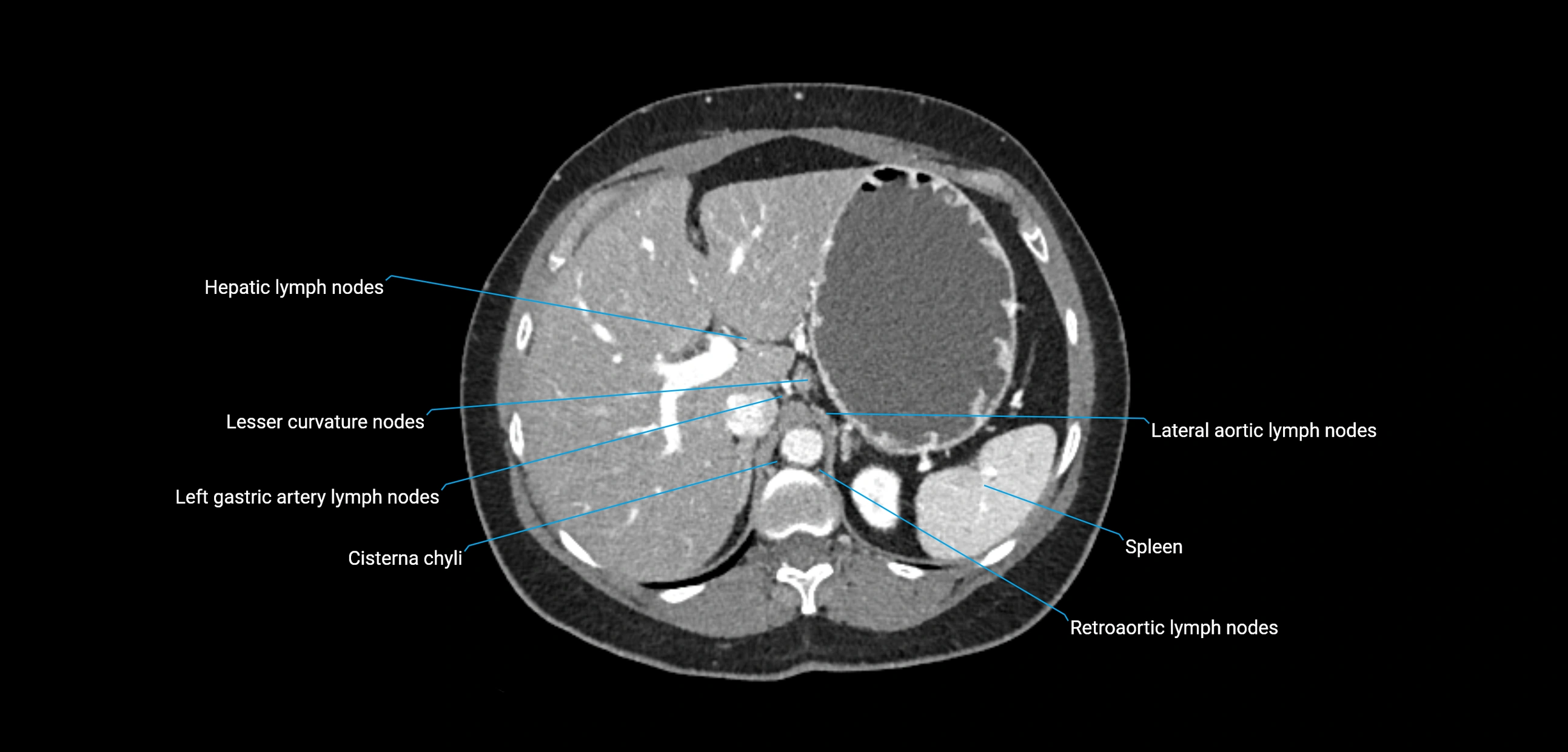 CT ct abdominal lymph nodes  axial cross sectional anatomy  enchanced radiology image -img-00002-00126.webp